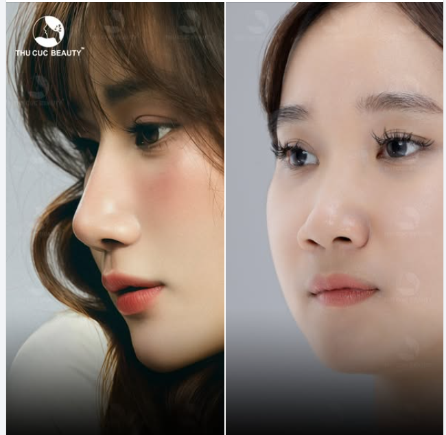 Nâng mũi Tự nhiên. Mềm mại. Chuẩn tỷ lệ vàng