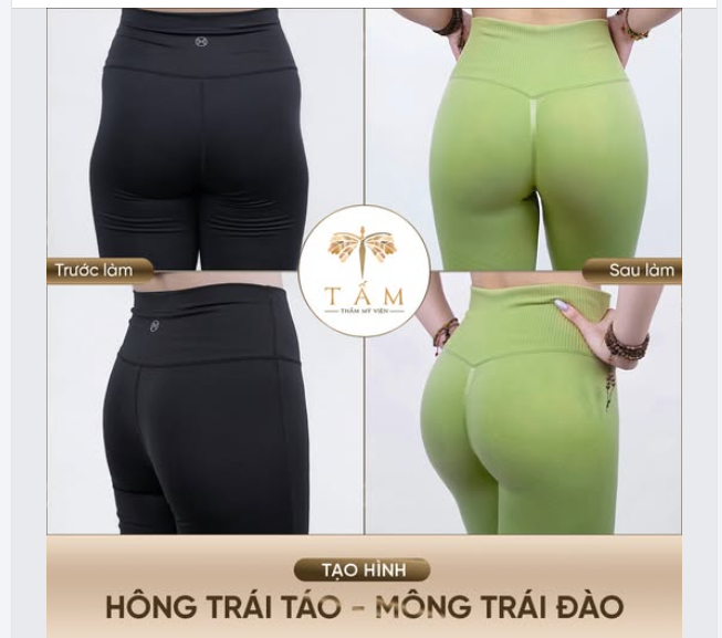 FILLER MÔNG - GIẢI PHÁP NHANH CHÓNG CHO VÒNG 3 ĐỦ: