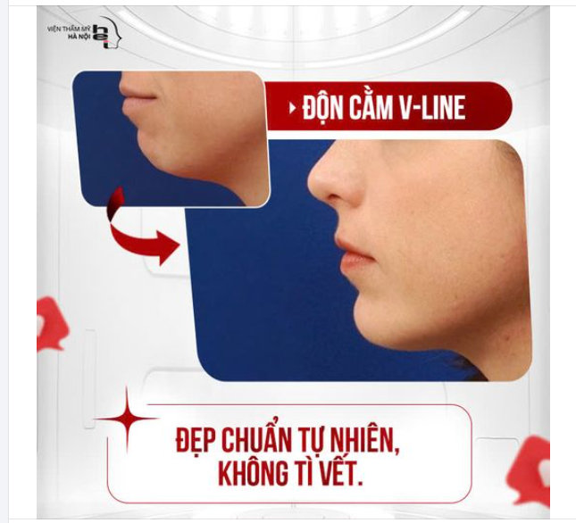 ĐỘN CẰM VLINE   Đẹp chuẩn tự nhiên - không tì vết 