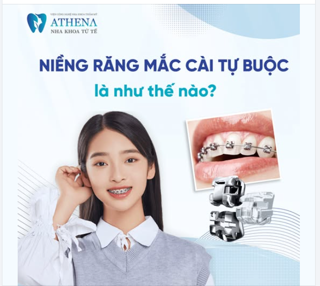 Ưu điểm nổi bật của mắc cài tự buộc