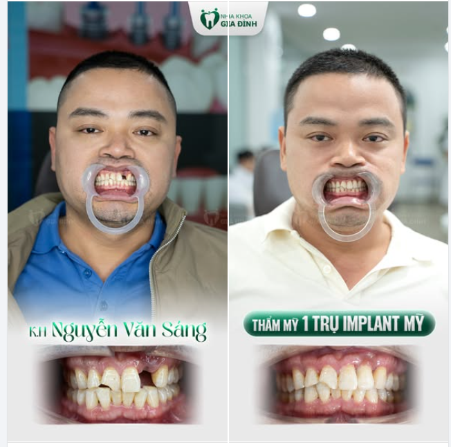 TRỒNG IMPLANT MAU ĐỂ MẤT RĂNG CỬA KHÔNG CÒN LÀ NỖI ĐAU