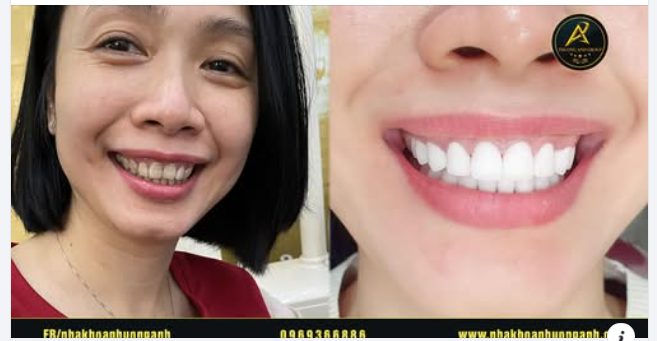 Những yếu tố quyết định đến thẩm mỹ nụ cười