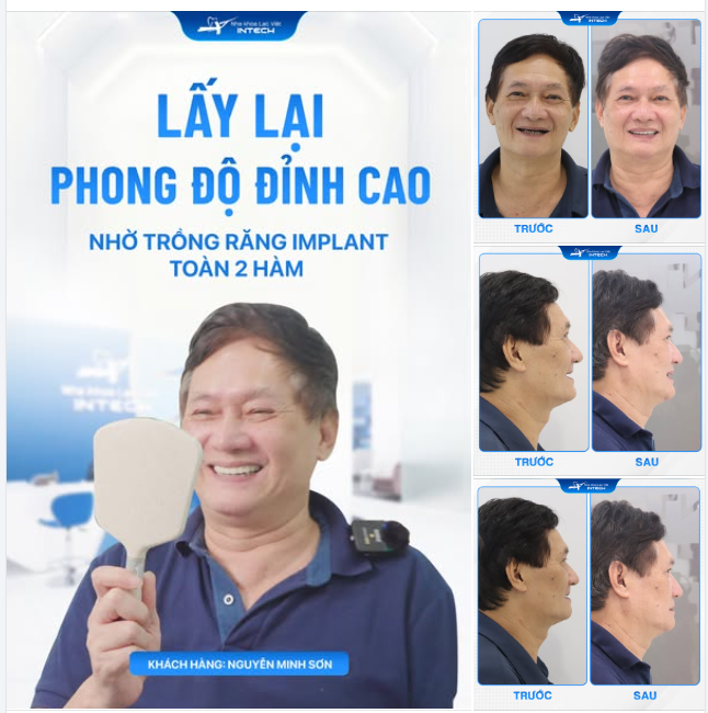 LẤY LẠI PHONG ĐỘ ĐỈNH CAO NHỜ TRỒNG RĂNG IMPLANT TOÀN 2 HÀM