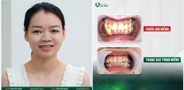 NIỀNG RĂNG NGAY ĐỂ ĐỔI LẠI NỤ CƯỜI CHUẨN TỰ TIN