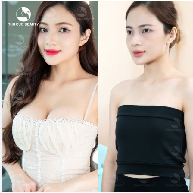 Ngực TC 39.9Tr Chia tay V1 teo lép, lệch khiến chị em ngần ngại lựa chọn outfit