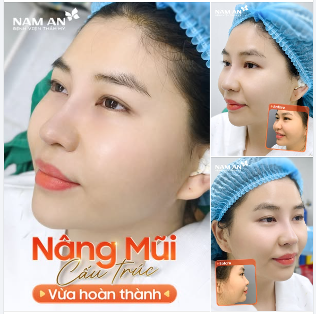 DÁNG MŨI CẤU TRÚC VỪA HOÀN THÀNH