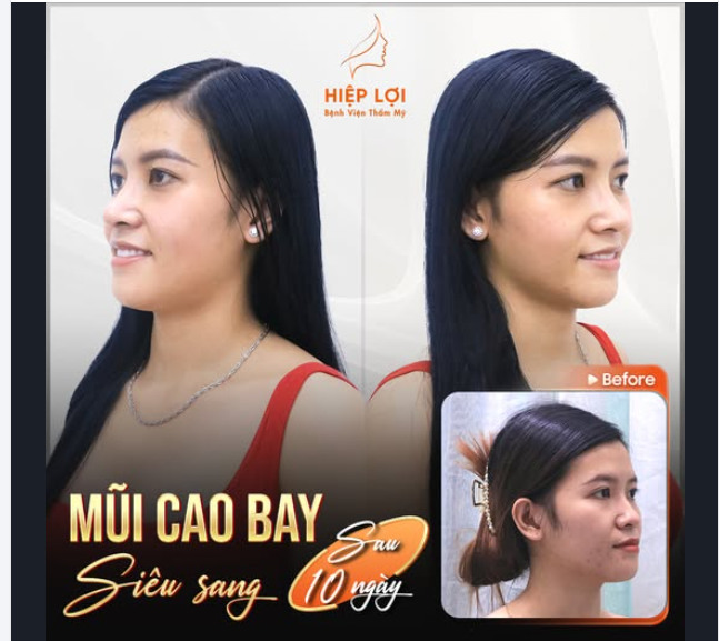 MŨI CAO BAY SIÊU SANG - Chỉ sau 10 ngày với giá cực ưu đãi