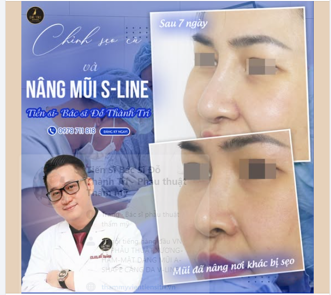 Sửa lại mũi đẹp cho khách để khách chuẩn bị thi hoa hậu