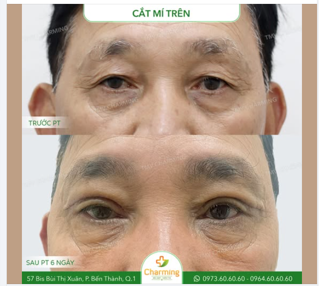 Chú khách của TMV Charming đã quyết định cải thiện vẻ ngoài bằng phương pháp cắt mí trên, một lựa chọn giúp đôi mắt trở nên tươi sáng và trẻ trung hơn.