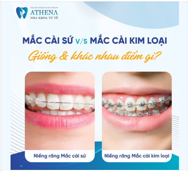  So sánh mắc cài kim loại và mắc cài sứ
