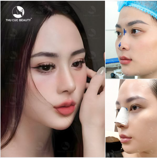 Nâng Mũi TC 11.9Tr Giải cứu sống mũi tẹt, cánh mũi to bè