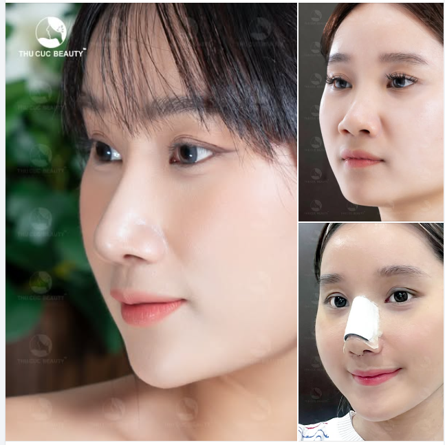 Nâng mũi 30P thực hiện loại bỏ tình trạng mũi thấp, đầu mũi to