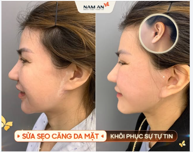 HỆ LỤY TỪ CĂNG DA KHÔNG ĐÚNG KỸ THUẬT – ĐƯỜNG SẸO DÀI