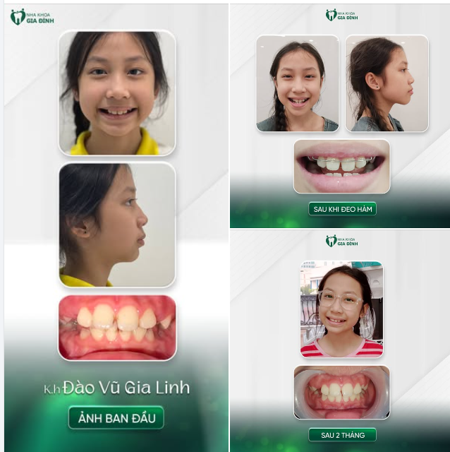 MỘT SỰ THAY ĐỔI TÍCH CỰC SAU 2 THÁNG ĐIỀU TRỊ TIỀN CHỈNH NHA