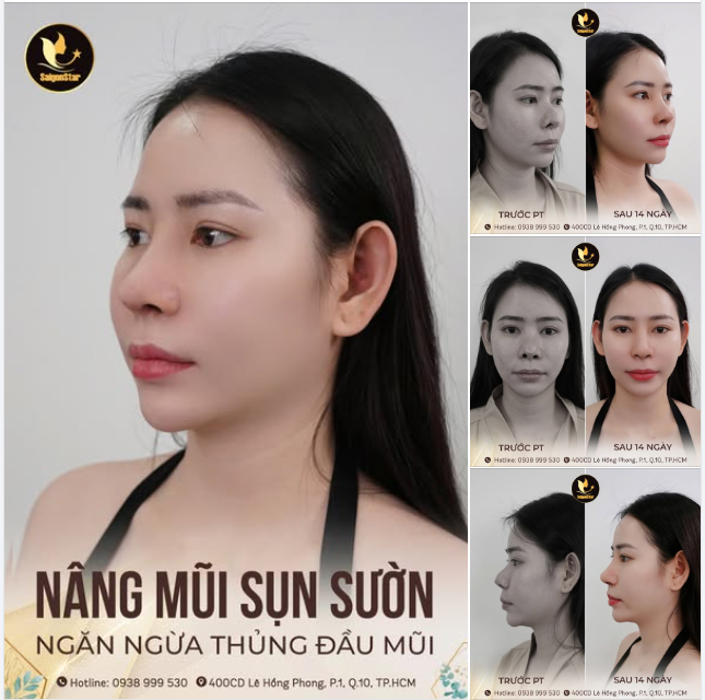 SAU 14 NGÀY NÂNG MŨI SỤN SƯỜN - "GIẢI CỨU" THÀNH CÔNG MŨI HỎNG KH. KIM SƯƠNG