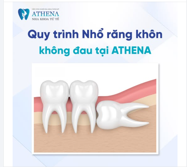 Trải nghiệm quy trình Nhổ răng khôn bằng máy Piezotome tại  Nha Khoa ATHENA