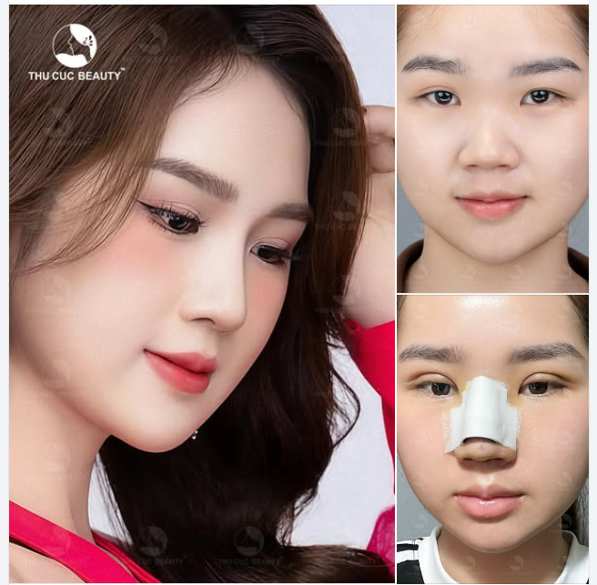 Nâng mũi chuẩn Tự tin khoe góc nghiêng. Đẹp mọi khung hình