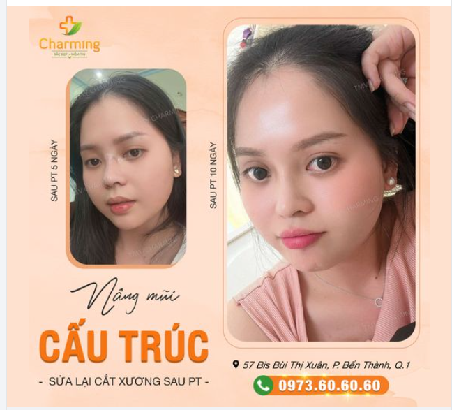 Nàng sau khi thực hiện nâng mũi cấu trúc sụn sườn sửa lại và cắt cánh mũi tại Charming xong trông xinh xỉu luôn.