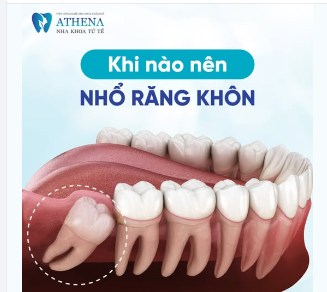 Thời điểm vàng để nhổ răng khôn