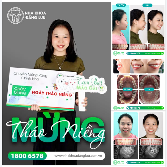 THÁO NIỀNG, CHECK!!!  Chúc mừng Tân Tháo Niềng-er: Chung Hoa