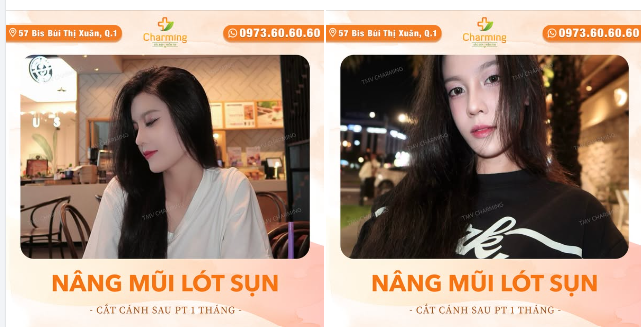 Nàng khách hàng dễ thương này đã có một màn thay đổi siêu ấn tượng sau khi thực hiện nâng mũi lót sụn và cắt cánh mũi tại TMV Charming.