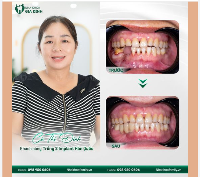 TRỒNG RĂNG IMPLANT - NỤ CƯỜI TỰ TIN ĐẾN SUỐT ĐỜI