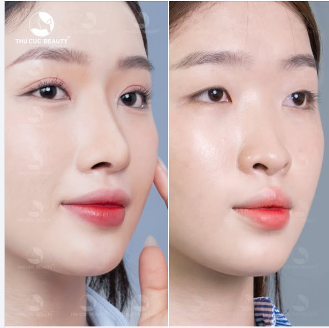 Bạn gái sau khi đến TC Sở hữu ngay mũi cao, hài hòa, tự nhiên