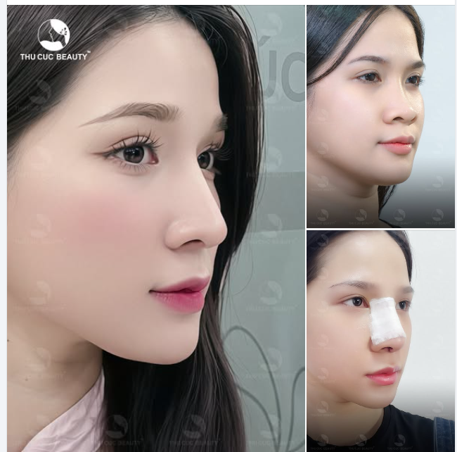 Hãy yên tâm đến TC để nâng mũi