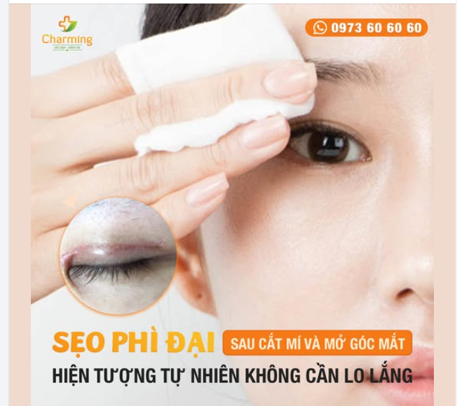 SẸO PHÌ ĐẠI SAU MỞ GÓC MẮT HOẶC CẮT MÍ – HIỆN TƯỢNG TỰ NHIÊN KHÔNG CẦN LO LẮNG