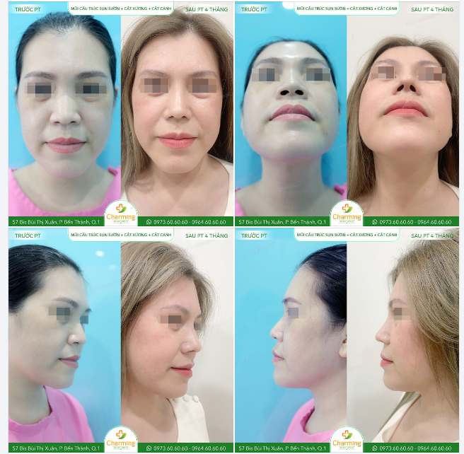 Trước khi bước vào hành trình "lột xác", nàng khách của chúng ta có một chiếc mũi không cân xứng, phần sóng mũi thấp và đầu mũi hơi hếch, khiến khuôn mặt trông thiếu hài hòa.