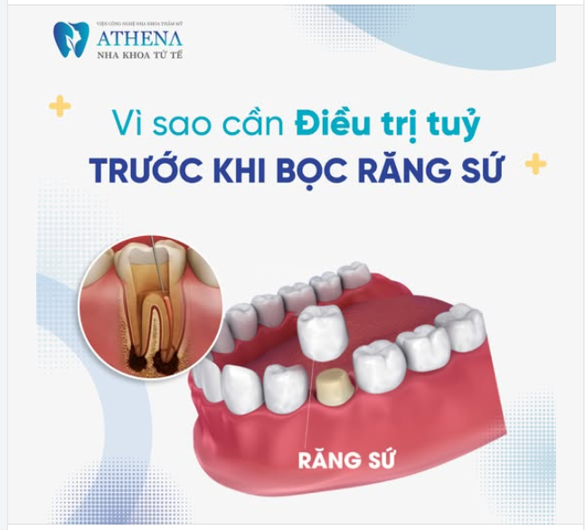 Tại sao cần Điều trị tủy răng trước khi bọc răng sứ