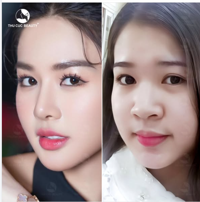 Đến TC để xóa sổ chiếc mũi tẹt