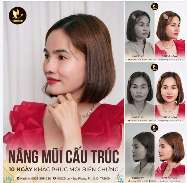 CẬN CẢNH NHAN SẮC RẠNG NGỜI SAU 10 NGÀY NÂNG MŨI SỬA LẠI