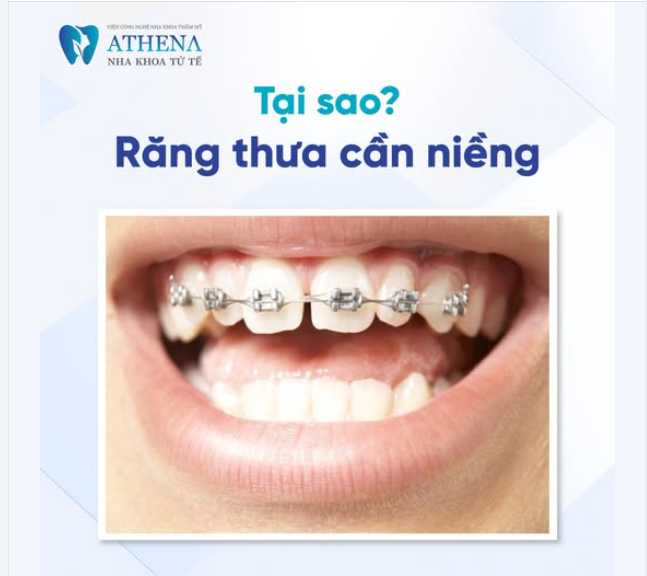 Tại sao cần niềng răng thưa?