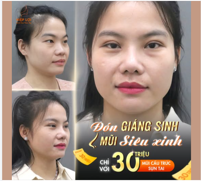 Lễ Giáng Sinh năm nay là cơ hội tuyệt vời để bạn sở hữu chiếc mũi "thanh tú", "chuẩn" với mức giá cực ưu đãi!