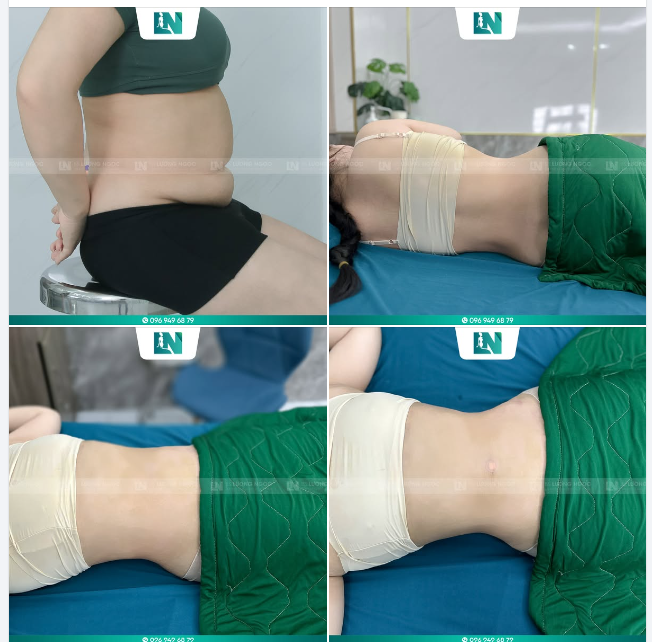 SIÊU PHẨM SAU 1 NGÀY HÚT MỠ SIẾT EO