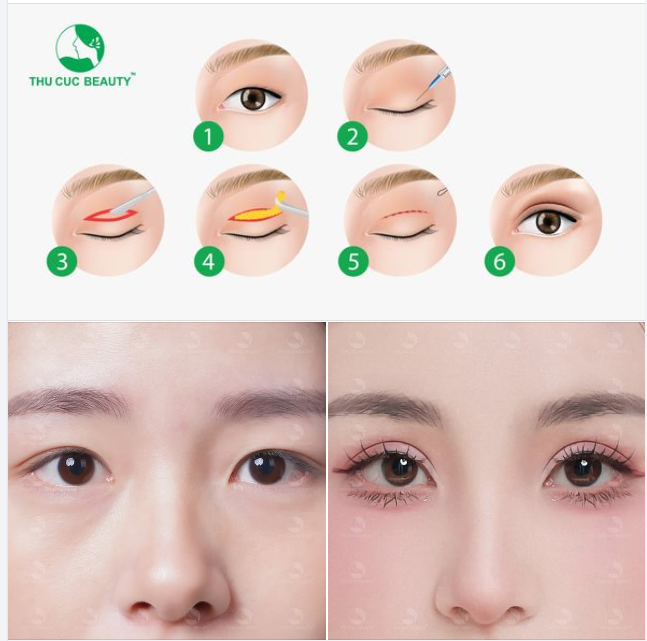 TC Thiết kế khuôn mí phù hợp với từng khách hàng