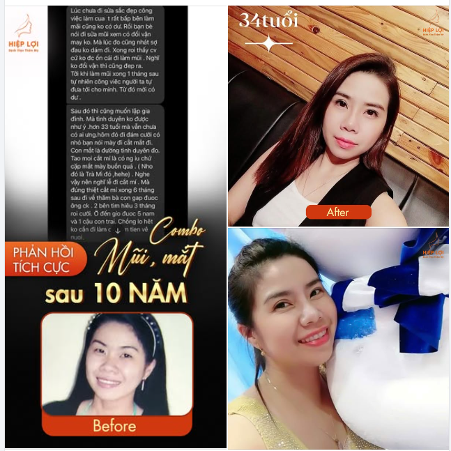 Chị Thư cho biết dáng mũi và mí mắt sau thẩm mỹ rất tự nhiên, phù hợp với gương mặt giúp chị cảm thấy tự tin và có cuộc sống trọn vẹn bên gia đình như hiện tại.