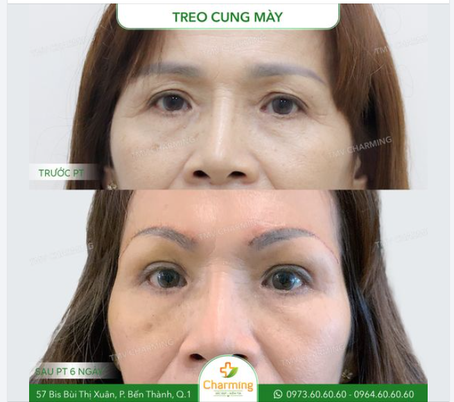 Nhìn hình ảnh trước và sau khi treo cung mày của cô khách hàng, có thể thấy rõ sự thay đổi đáng kể.