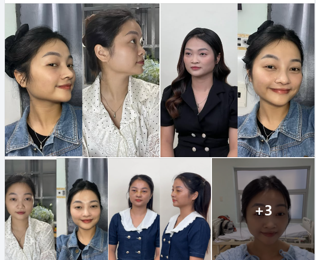 Tui HỐI HẬN khi không làm mũi tại AZ NOSE sớm hơn