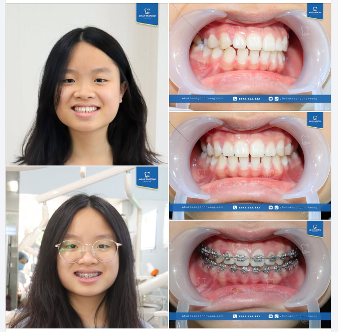 Tái tạo nụ cười đón tuổi mới cùng Vân Anh