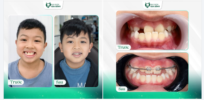 4 THÁNG ĐỂ CẢI THIỆN NỤ CƯỜI CHO BÉ