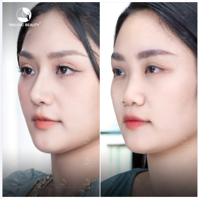 Khuôn mặt trở lên rạng ngời tự tin sau nâng mũi TC