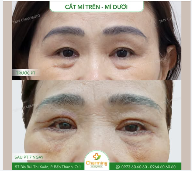 Cô khách hàng này đã hoàn toàn thay đổi diện mạo chỉ sau một lần thực hiện cắt mí trên và mí dưới tại TMV Charming.