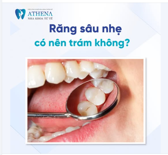 Răng sâu nhẹ có nên trám không?