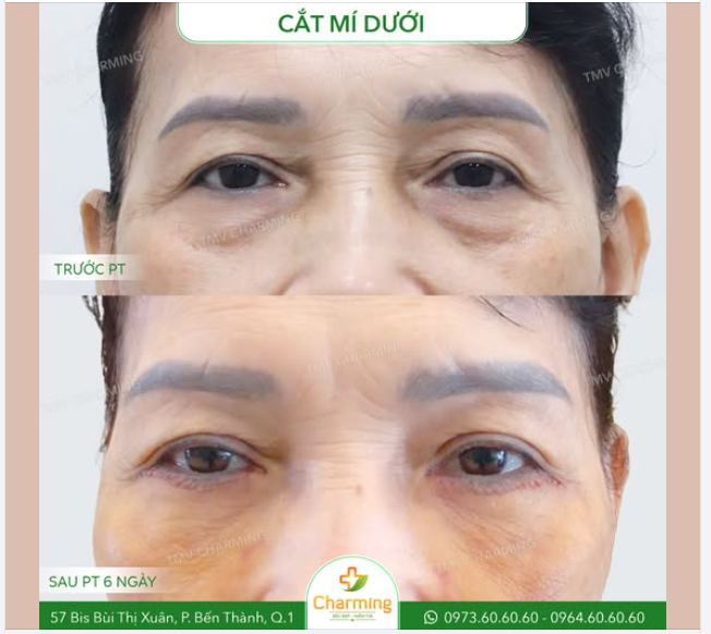 Đôi mắt của cô khách đã trải qua những dấu ấn thời gian với phần bọng mỡ mí dưới khiến gương mặt trông kém rạng rỡ.