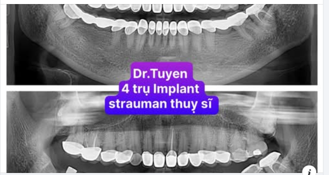 Tại sao mất một chiếc răng có thể ảnh hưởng đến toàn bộ hàm răng?
