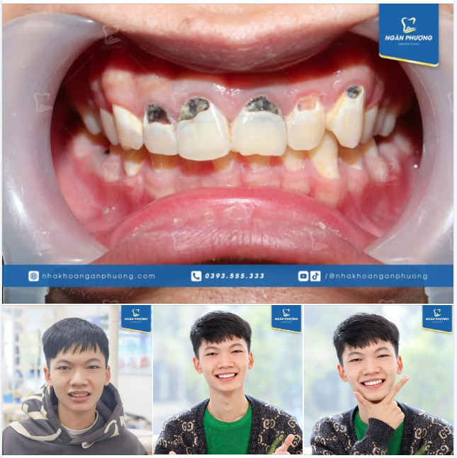 Bọc sứ khắc phục thiểu sản men răng cho bạn Hữu Tính