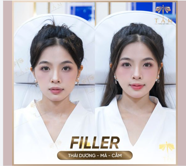 Quỳnh Anh với tình trạng má hóp, cằm ngắn, thái dương hõm sâu.