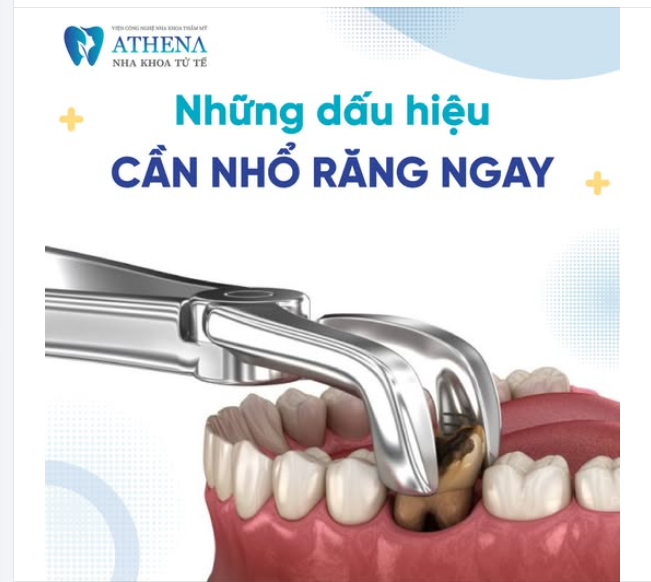 Dấu hiệu cần nhổ răng– Hãy lưu ý trước khi quá muộn